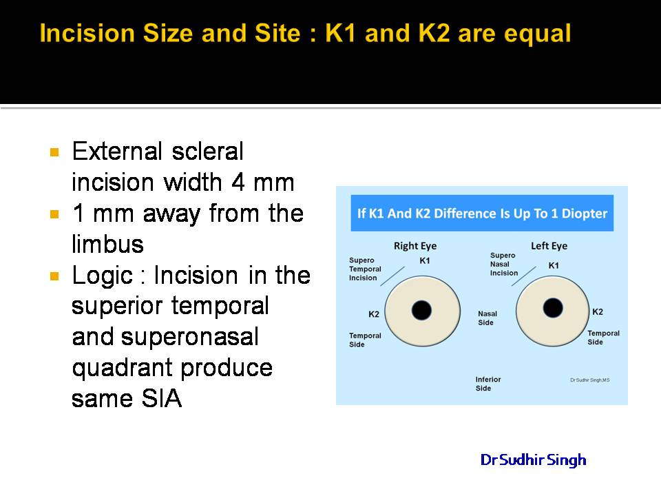 Incisions Planning In Manual Small Incision Cataract Surgery